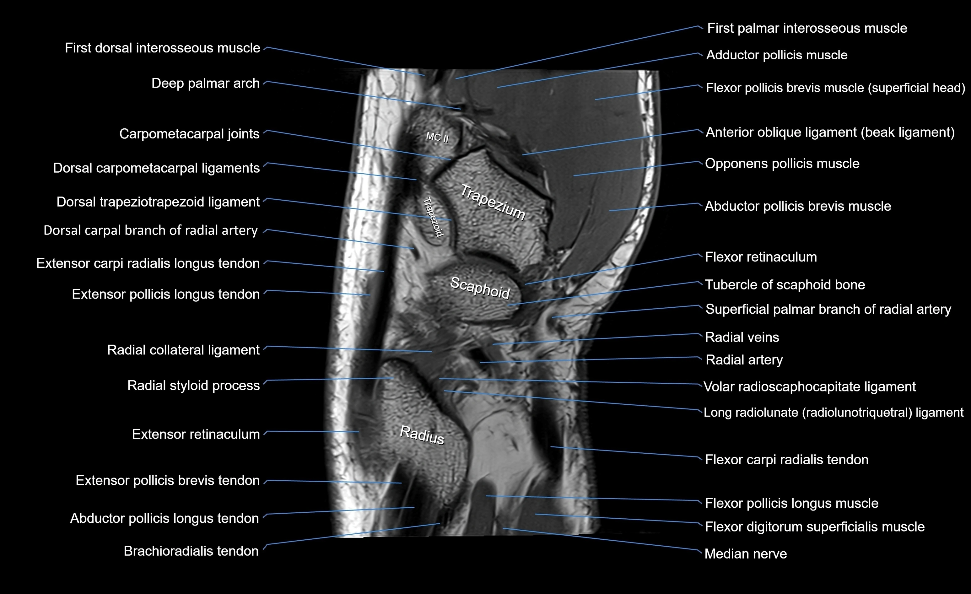 MRI wrist sagittal cross sectional anatomy 3T  radiology  image-img-00001-00006.webp